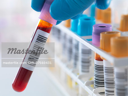 A blood sample being held with a row of human samples for analytical testing including blood, urine, chemistry, proteins, anticoagulants and HIV in lab