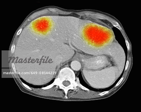 Image from a co-registered PET-CT study from dual modality scanner. Patient with multiple metastatic lesions in liver & lung. PET data superimposed over CT scan axial slice through liver metastases