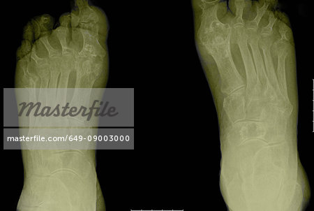 X-ray showing arthritic feet