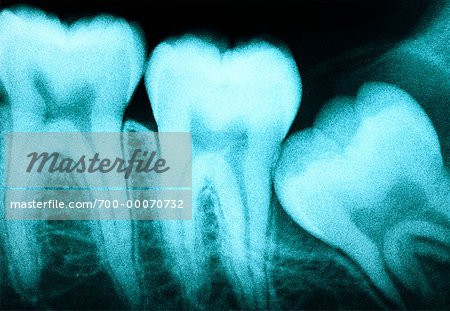 X-Ray of Impacted Wisdom Tooth