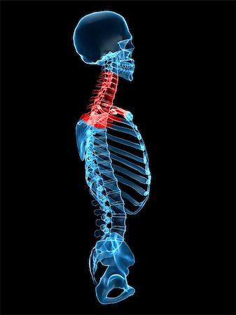 simsearch:400-04163427,k - 3d rendered x-ray illustration of a human torso with a painful neck Stock Photo - Budget Royalty-Free & Subscription, Code: 400-04008303