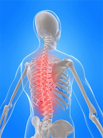 simsearch:400-04003518,k - 3d rendered x-ray illustration of a human skeletal back with a painful spine Fotografie stock - Microstock e Abbonamento, Codice: 400-04003517