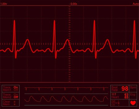 elettrocardiogramma - heart monitor screen with normal beat signal Fotografie stock - Microstock e Abbonamento, Codice: 400-04018261