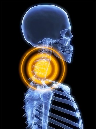 simsearch:400-04008303,k - 3d rendered x-ray illustration of a human head with neck pain Stockbilder - Microstock & Abonnement, Bildnummer: 400-04012469