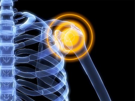 simsearch:400-05311566,k - 3d rendered x-ray illustration of a human shoulder with pain Stockbilder - Microstock & Abonnement, Bildnummer: 400-04012472