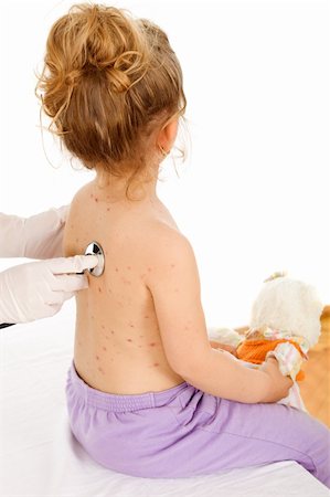 Physical exam of a little girl with a rash, small pox  or pimples on her skin - isolated Stock Photo - Budget Royalty-Free & Subscription, Code: 400-04129532