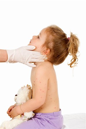 rubber nurse - Little kid at the doctors with a severe skin rash or small pox - isolated, side view Stock Photo - Budget Royalty-Free & Subscription, Code: 400-04136486