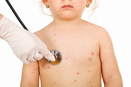 rubber nurse - Little kid with small pox examinated by a physician - isolated, closeup on torso - isolated Stock Photo - Budget Royalty-Free & Subscription, Code: 400-04136489