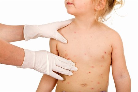 rubber nurse - Kid torso with small pox consulted by a physician - isolated, closeup Stock Photo - Budget Royalty-Free & Subscription, Code: 400-04136490