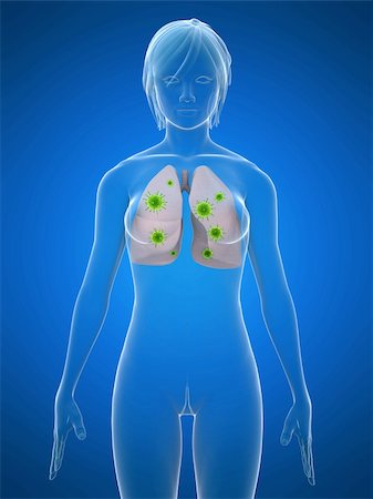pneumonia - 3d rendered illustration of a human body with bacteria in lung Stock Photo - Budget Royalty-Free & Subscription, Code: 400-04154348