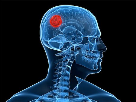 simsearch:400-05881910,k - 3d rendered x-ray illustration of a human head with tumor in brain Stockbilder - Microstock & Abonnement, Bildnummer: 400-04155388