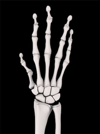 rheumatoid arthritis - 3d rendered x-ray illustration of a skeletal hand with arthritis Stock Photo - Budget Royalty-Free & Subscription, Code: 400-04157131