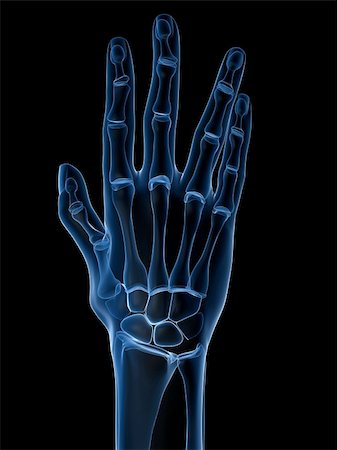 rheumatoid arthritis - 3d rendered x-ray illustration of a skeletal hand with arthritis Stock Photo - Budget Royalty-Free & Subscription, Code: 400-04157154