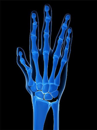 rheumatoid arthritis - 3d rendered x-ray illustration of a skeletal hand with arthritis Stock Photo - Budget Royalty-Free & Subscription, Code: 400-04157155