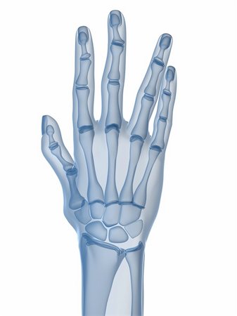 rheumatoid arthritis - 3d rendered x-ray illustration of a skeletal hand with arthritis Stock Photo - Budget Royalty-Free & Subscription, Code: 400-04157156