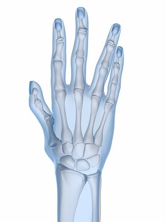 entzündung - 3d rendered x-ray illustration of a skeletal hand with arthritis Stockbilder - Microstock & Abonnement, Bildnummer: 400-04157157
