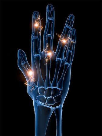 rheumatoid arthritis - 3d rendered x-ray illustration of a skeletal hand with arthritis Stock Photo - Budget Royalty-Free & Subscription, Code: 400-04157158