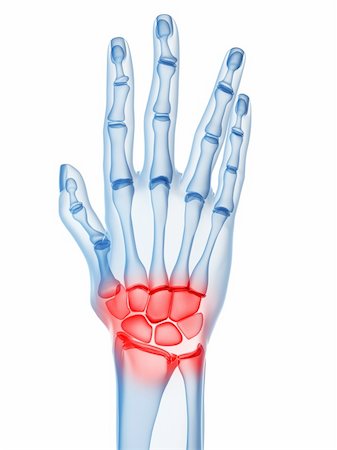 rheumatoid arthritis - 3d rendered x-ray illustration of a skeletal hand with arthritis Stock Photo - Budget Royalty-Free & Subscription, Code: 400-04157164