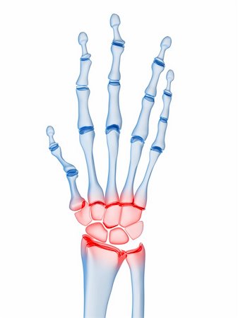 rheumatoid arthritis - 3d rendered x-ray illustration of a skeletal hand with arthritis Stock Photo - Budget Royalty-Free & Subscription, Code: 400-04157165