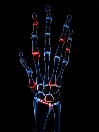 rheumatoid arthritis - 3d rendered x-ray illustration of a skeletal hand with arthritis Stock Photo - Budget Royalty-Free & Subscription, Code: 400-04157167