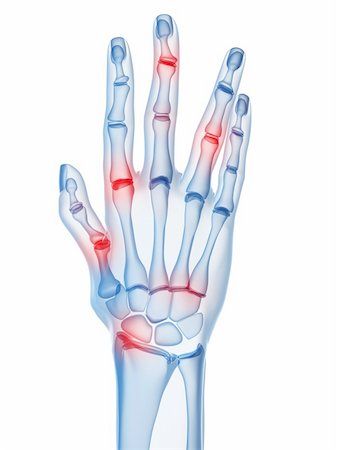 rheumatoid arthritis - 3d rendered x-ray illustration of a skeletal hand with arthritis Stock Photo - Budget Royalty-Free & Subscription, Code: 400-04157163