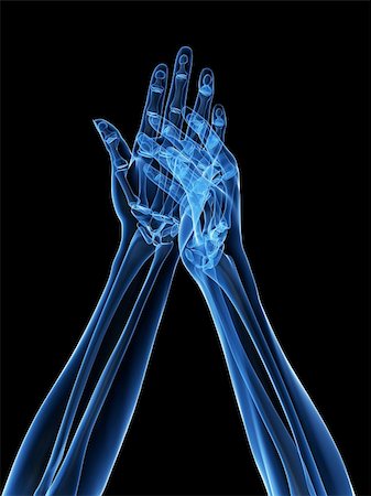 rheumatoid arthritis - 3d rendered x-ray illustration of human hands with arthritis in fingers Stock Photo - Budget Royalty-Free & Subscription, Code: 400-04163364