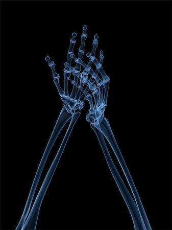 rheumatoid arthritis - 3d rendered x-ray illustration of human hands with arthritis in fingers Stock Photo - Budget Royalty-Free & Subscription, Code: 400-04163365