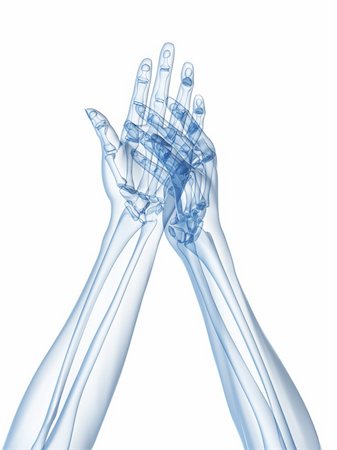 3d rendered x-ray illustration of human hands with arthritis in fingers Foto de stock - Super Valor sin royalties y Suscripción, Código: 400-04163367