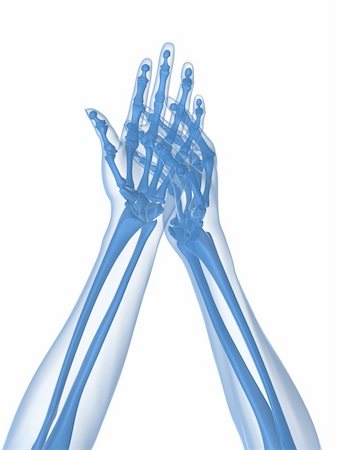 rheumatoid arthritis - 3d rendered x-ray illustration of human hands with arthritis in fingers Stock Photo - Budget Royalty-Free & Subscription, Code: 400-04163368
