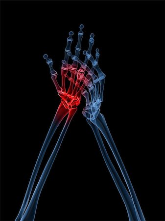 rheumatoid arthritis - 3d rendered x-ray illustration of human highlighted hand Stock Photo - Budget Royalty-Free & Subscription, Code: 400-04163396