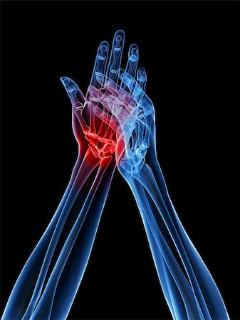 rheumatoid arthritis - 3d rendered x-ray illustration of human highlighted hand Stock Photo - Budget Royalty-Free & Subscription, Code: 400-04163397