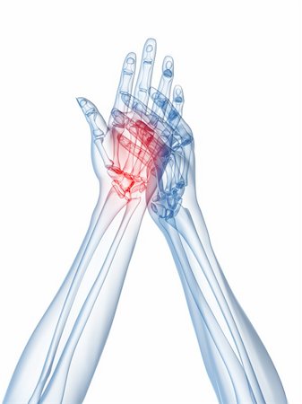 rheumatoid arthritis - 3d rendered x-ray illustration of human highlighted hand Stock Photo - Budget Royalty-Free & Subscription, Code: 400-04163399