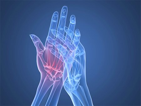 rheumatoid arthritis - 3d rendered x-ray illustration of human highlighted hand Stock Photo - Budget Royalty-Free & Subscription, Code: 400-04163392