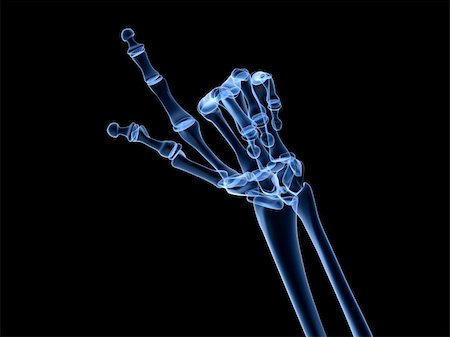 rheumatoid arthritis - 3d rendered x-ray illustration of human skeletal hand Stock Photo - Budget Royalty-Free & Subscription, Code: 400-04163625