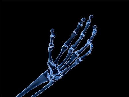 rheumatoid arthritis - 3d rendered x-ray illustration of human skeletal hand Stock Photo - Budget Royalty-Free & Subscription, Code: 400-04163623