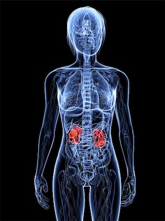 3d rendered illustration of a transparent female body with tumor in kidney Stock Photo - Budget Royalty-Free & Subscription, Code: 400-04189470