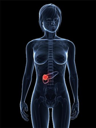 3d rendered illustration of a transparent female body with tumor in pancreas Stock Photo - Budget Royalty-Free & Subscription, Code: 400-04189498