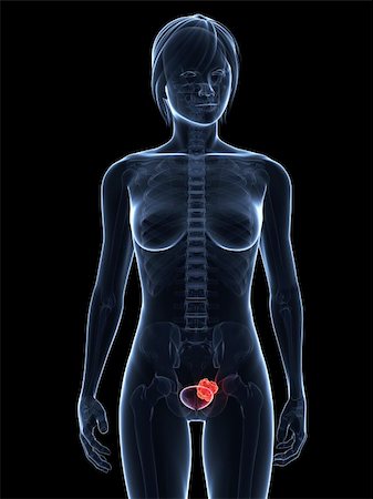 3d rendered illustration of a transparent female body with tumor in bladder Stock Photo - Budget Royalty-Free & Subscription, Code: 400-04189502