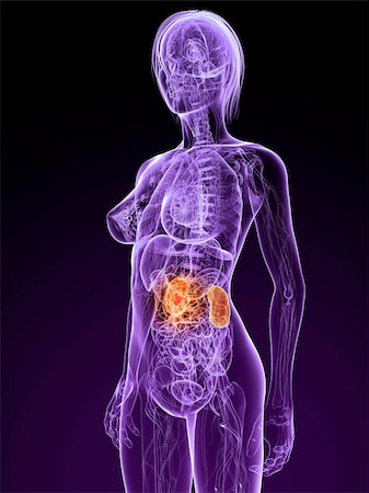 stomach cancer color - 3d rendered illustration of a transparent female body with tumor in kidney Stock Photo - Budget Royalty-Free & Subscription, Code: 400-04189513