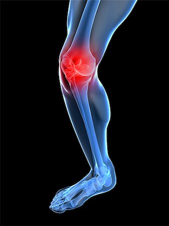 3d rendered illustration of a skeletal knee with painful joint Stock Photo - Budget Royalty-Free & Subscription, Code: 400-04189654