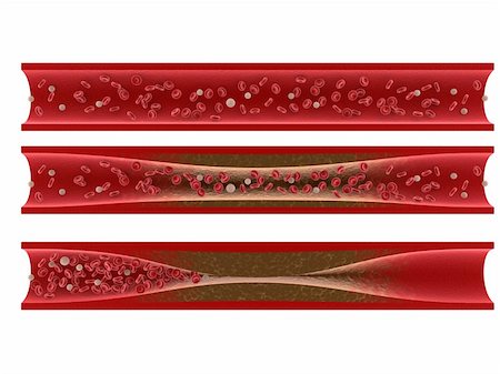 3d rendered illustration from a cut of arterys with arteriosclerosis Stock Photo - Budget Royalty-Free & Subscription, Code: 400-04189813