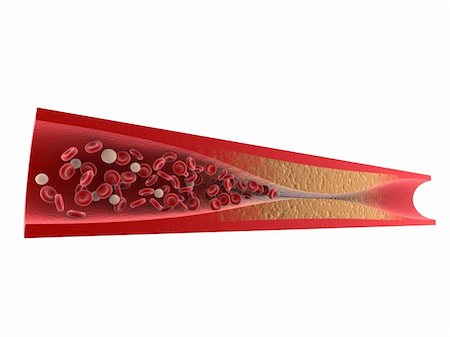 3d rendered illustration from a cut of an artery with arteriosclerosis Stock Photo - Budget Royalty-Free & Subscription, Code: 400-04189849