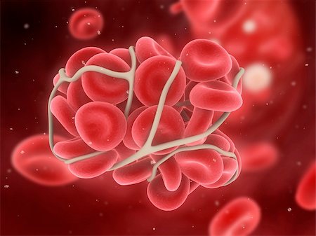 3d rendered illustration of a blood clot in an artery Stockbilder - Microstock & Abonnement, Bildnummer: 400-04189841
