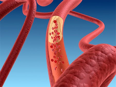 3d rendered illustration of an artery with arteriosklerosis Stock Photo - Budget Royalty-Free & Subscription, Code: 400-04191063