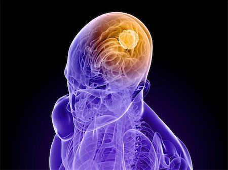 3d rendered illustration of a transparent head with tumor in brain Foto de stock - Super Valor sin royalties y Suscripción, Código: 400-04191128