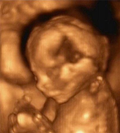 pregnant scan - Three Dimensional Ultrasonography of Fourth Month Fetus Foto de stock - Super Valor sin royalties y Suscripción, Código: 400-04241371