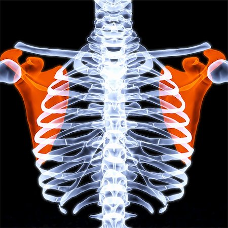 fratura - human thorax under X-rays. scapula are highlighted in red. Foto de stock - Royalty-Free Super Valor e Assinatura, Número: 400-04272888