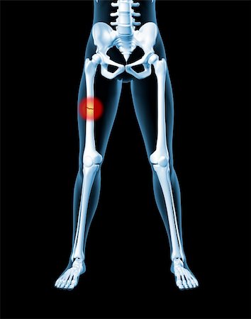 fractured bone - 3D render of a medical female skeleton with a broken leg bone highlighted Stock Photo - Budget Royalty-Free & Subscription, Code: 400-04291186