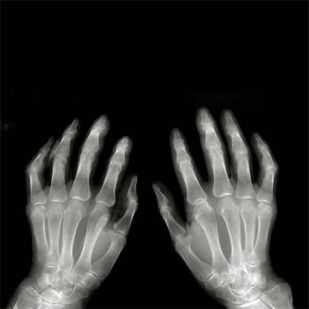 pictures of broken bones in xray - Hands on X-ray film Stock Photo - Budget Royalty-Free & Subscription, Code: 400-04322818