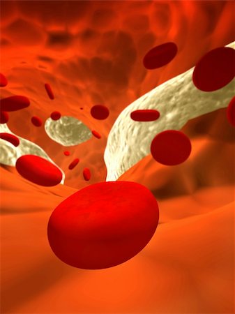 Atherosclerosis - clogged artery and erythrocytes Stock Photo - Budget Royalty-Free & Subscription, Code: 400-04389638